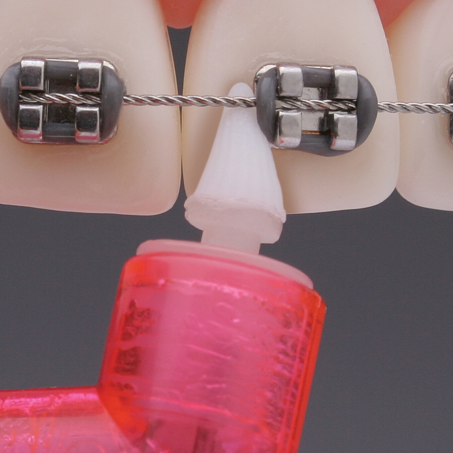 Ortho Brackets with 2pro