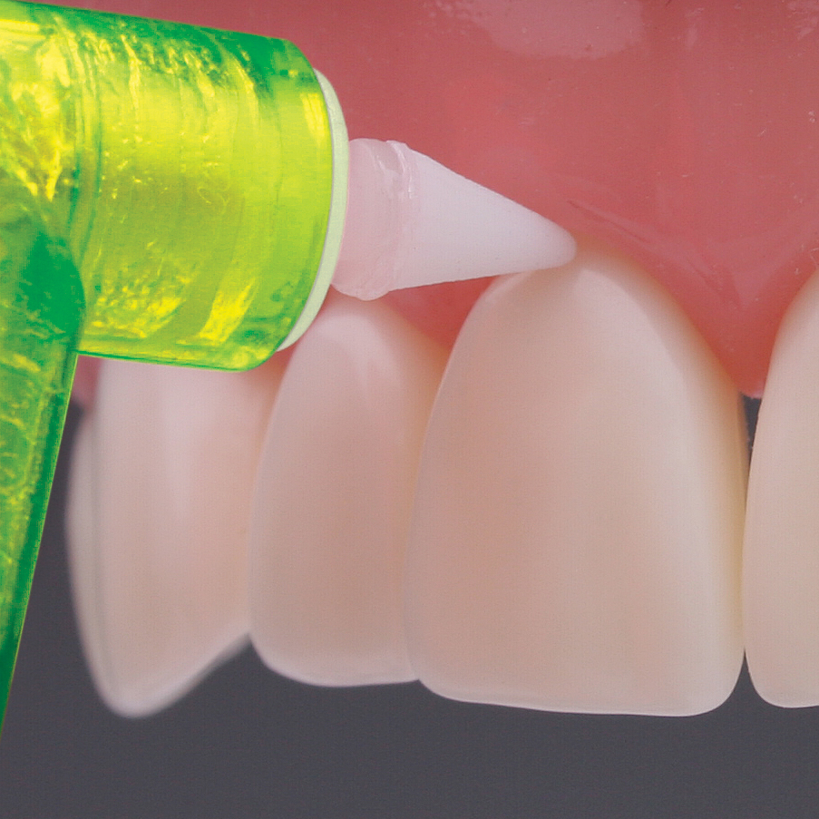 Veneer Margins with 2pro