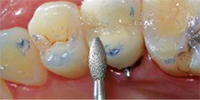 Intra-Oral-Adjustment