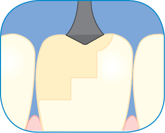 CMI technique
