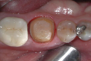 Tooth Before Premier 6