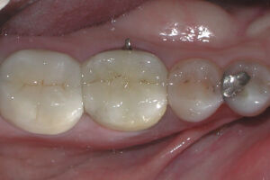 Tooth Before Premier 8