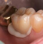 ZR-Cem - Zirconia Cementation Solution