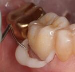 ZR-Cem - Zirconia Cementation Solution