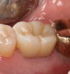 ZR-Cem - Zirconia Cementation Solution