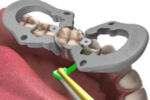 Premier X5 Sectional Matrix System - Mesial & Distal Ring Placement