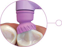 ProFlare - contours to each tooth