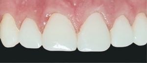 VeneerNow After Image