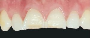 VeneerNow Before Image