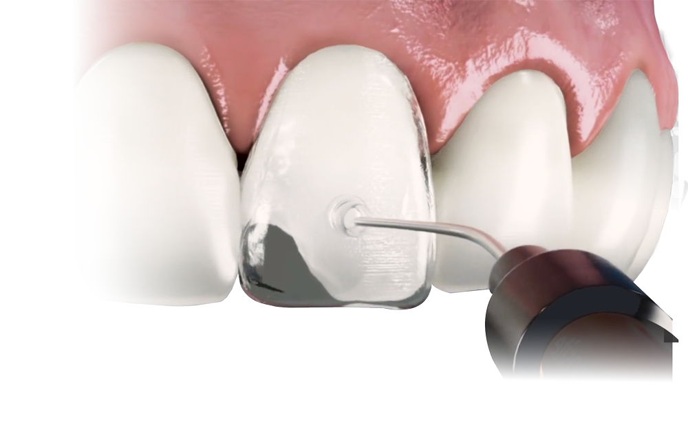 VeneerNow - Injectable Matrix System