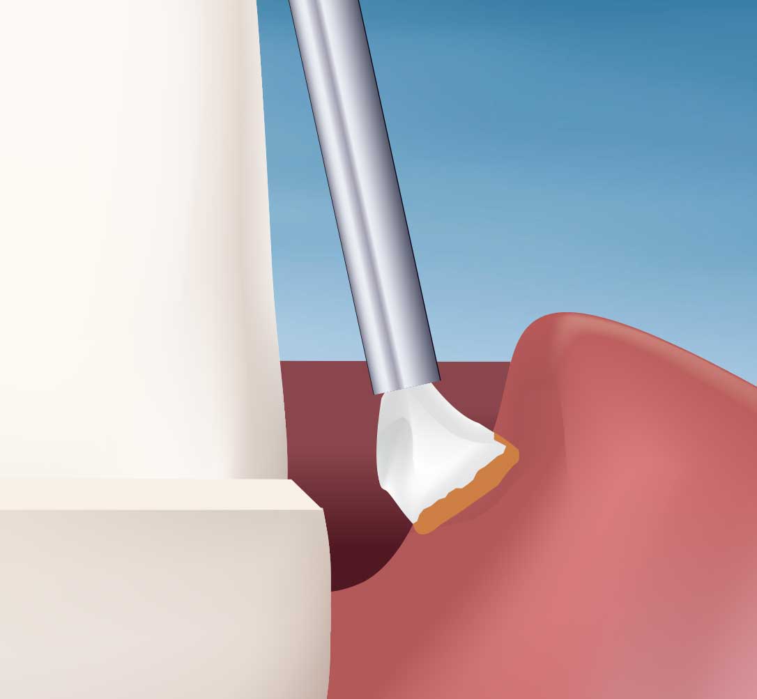 Traxodent Gel Technique, Step 1