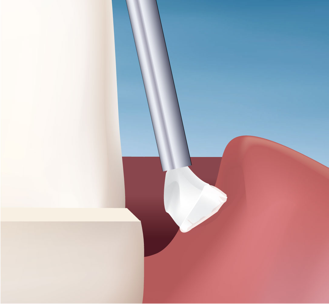 Traxodent Gel Technique, Step 1